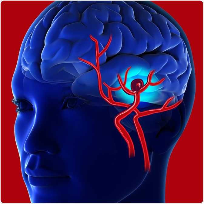 Cerebral aneurysm illustration. Image Credit: Romanova Natali / Shutterstock