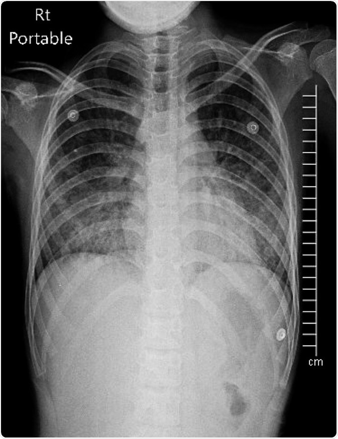 Acute respiratory distress syndrome on Chest X-ray PA upright. Image Credit: Chalie Chulapornsiri / Shutterstock