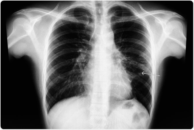 Chest X-ray known case S/P left anterior mediastinum mass. The study shows recticulo-fibrosis at medial perihilar LUL, and small tenting LLL basal fibrosis. Cardiac contour and rib cages are intact. Image Credit: Good Image Studio