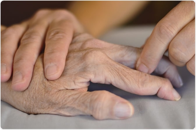 Rheumatoid arthritis fingers. Image Credit: Karen Amundson / Shutterstock