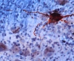 Study refutes link between increased levels of herpes virus and Alzheimer's disease