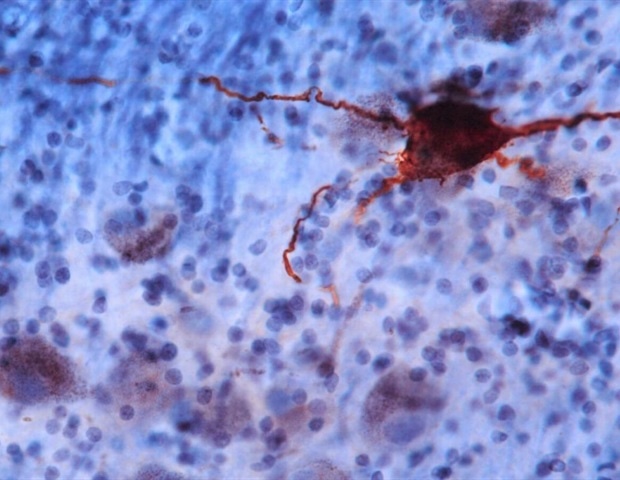 Study reveals CNTN4 gene's role in neuronal development and Alzheimer's disease pathogenesis