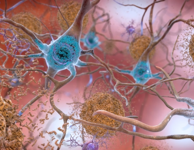 Study identifies APOE4 homozygotes as high-risk group for Alzheimer's disease