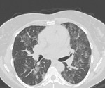 New virtual tool to help the world diagnose COVID-19 in the lungs