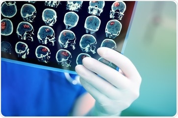 Insights into diagnosis and treatment of rare pediatric brain cancer