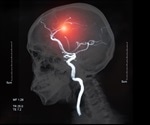 What is Cerebrovascular Disease?