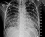What is Acute Respiratory Distress Syndrome (ARDS)?
