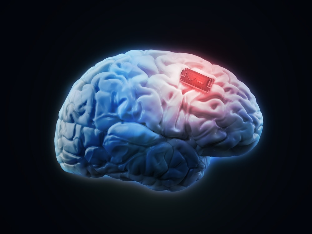 implante do cérebro