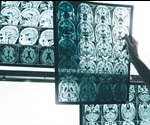 Blood Flow Through the Brain & Alzheimer’s Disease