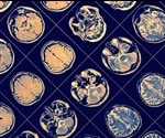 Differences in the Brains of People with Severe Mental Illnesses