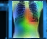 AI could enhance prediction of treatment response among patients with non-small cell lung cancer
