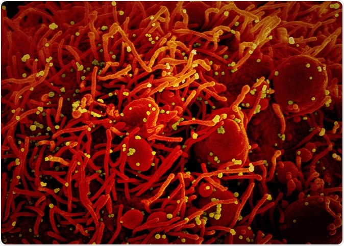 NIAIDFollow Novel Coronavirus SARS-CoV-2 Colorized scanning electron micrograph of an apoptotic cell (red) infected with SARS-COV-2 virus particles (yellow), isolated from a patient sample. Image captured at the NIAID Integrated Research Facility (IRF) in Fort Detrick, Maryland. Credit: NIAID