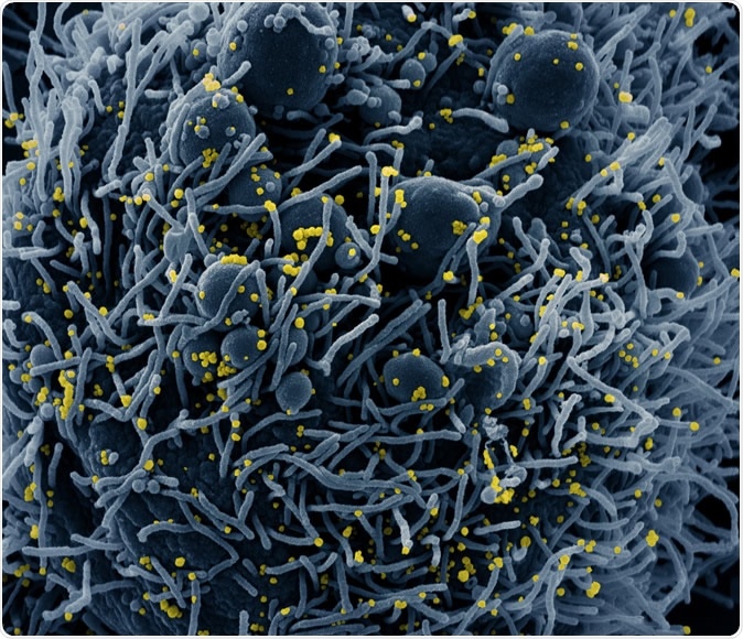Colorized scanning electron micrograph of an apoptotic cell (blue) infected with SARS-COV-2 virus particles (yellow), isolated from a patient sample. Image captured at the NIAID Integrated Research Facility (IRF) in Fort Detrick, Maryland. Credit: NIAID