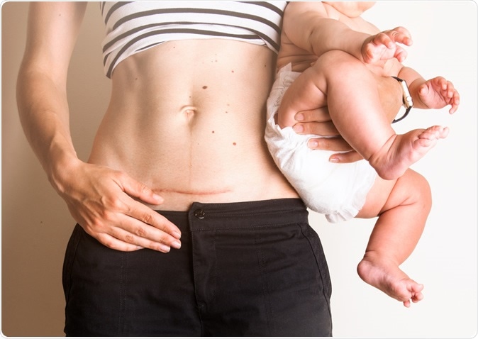 The study found an association between being born by cesarean delivery and increased risks of obesity and type 2 diabetes in adulthood. Image Credit: Troyan / Shutterstock