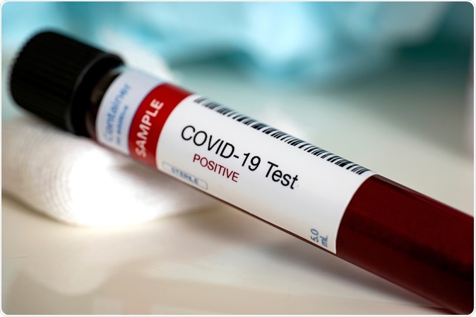 The antibody test is performed as a standard blood test using one vial of blood. Image Credit: Myriam B / Shutterstock