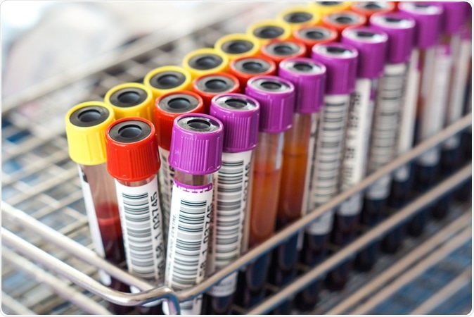 Study - A novel high specificity COVID-19 screening method based on simple blood exams and artificial intelligence. Image Credit: wk1003mike / Shutterstock