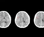Is Reversing Brain Damage Possible?