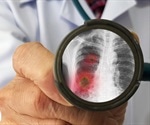 Elderly patients underestimate the danger of pneumonia