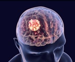 Treating Brain Tumors