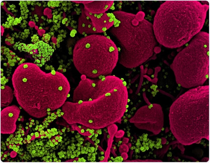 Novel Coronavirus SARS-CoV-2 Colorized scanning electron micrograph of an apoptotic cell (pink) heavily infected with SARS-COV-2 virus particles (green), isolated from a patient sample. Image captured at the NIAID Integrated Research Facility (IRF) in Fort Detrick, Maryland. Credit: NIAID