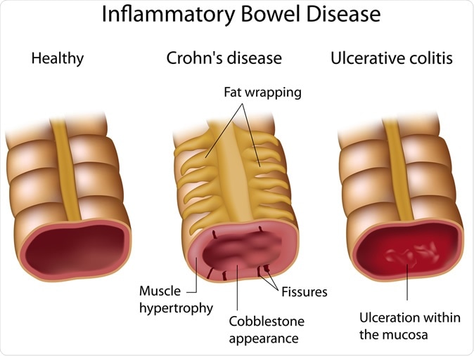 Crohns and Ulcerative colitis. Image Credit: Alila Medical Media / Shutterstock