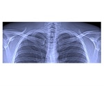 TUM researchers develop innovative x-ray method for lung diagnostics