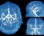 Why are Women More Likely to have Brain Aneurysms Compared to Men?