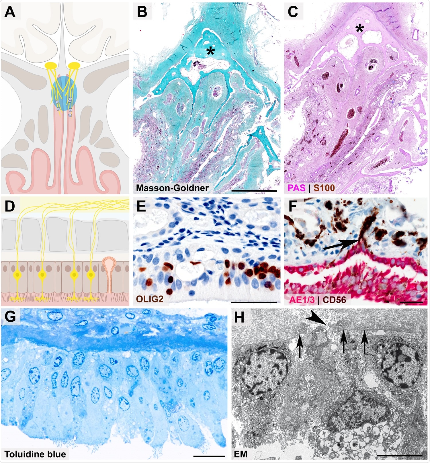Close anatomical proximity of nervous and epithelial tissues in the olfactory mucosa Cartoon (A) and histopathological coronal cross-sections (B - C) depicting the paranasal sinus region with the osseous cribriform plate (turquoise color and asterisk in B, pink color and asterisk in C) and the close anatomical proximity of the olfactory mucosa (green in B, purple in C) and nervous tissue characterized by nerve fibers immunoreactive for S100 protein (C, brown color). Cartoon (D) resembling the olfactory mucosa, which is composed of pseudostratified ciliated columnar epithelium, basement membrane, and lamina propria, also containing mucus-secreting Bowman glands and bipolar olfactory receptor neurons (ORNs), which coalesce the epithelial layer. 368 Immunohistochemical staining of the olfactory mucosa (E, F) showing nuclear expression of OLIG2 specifying late neuronal progenitor and newly formed neurons (E, brown color)31 369 , which are closely intermingled with epithelial cells (F, immunoreactivity for the pancytokeratin marker AE1/3, red color). The basement membrane underneath the columnar AE1/3-positive epithelium (F, red color) is discontinued due to CD56-positive (F, brown color) axonal projections of ORNs (F, arrow). The ORN 3dendrite carries multiple cilia and protrudes into the nasal cavity (G, semithin section, toluidine blue staining), while the axon (H, arrowhead) crosses the olfactory mucosa basement membrane (H, 3arrows) as a precondition for ORN projection into the glomeruli of the olfactory bulb, which is readily 3visible at the ultrastructural level). Scale bars: B: 3.5 cm; E, F: 50 µm; G: 20 µm; H: 5 µm.