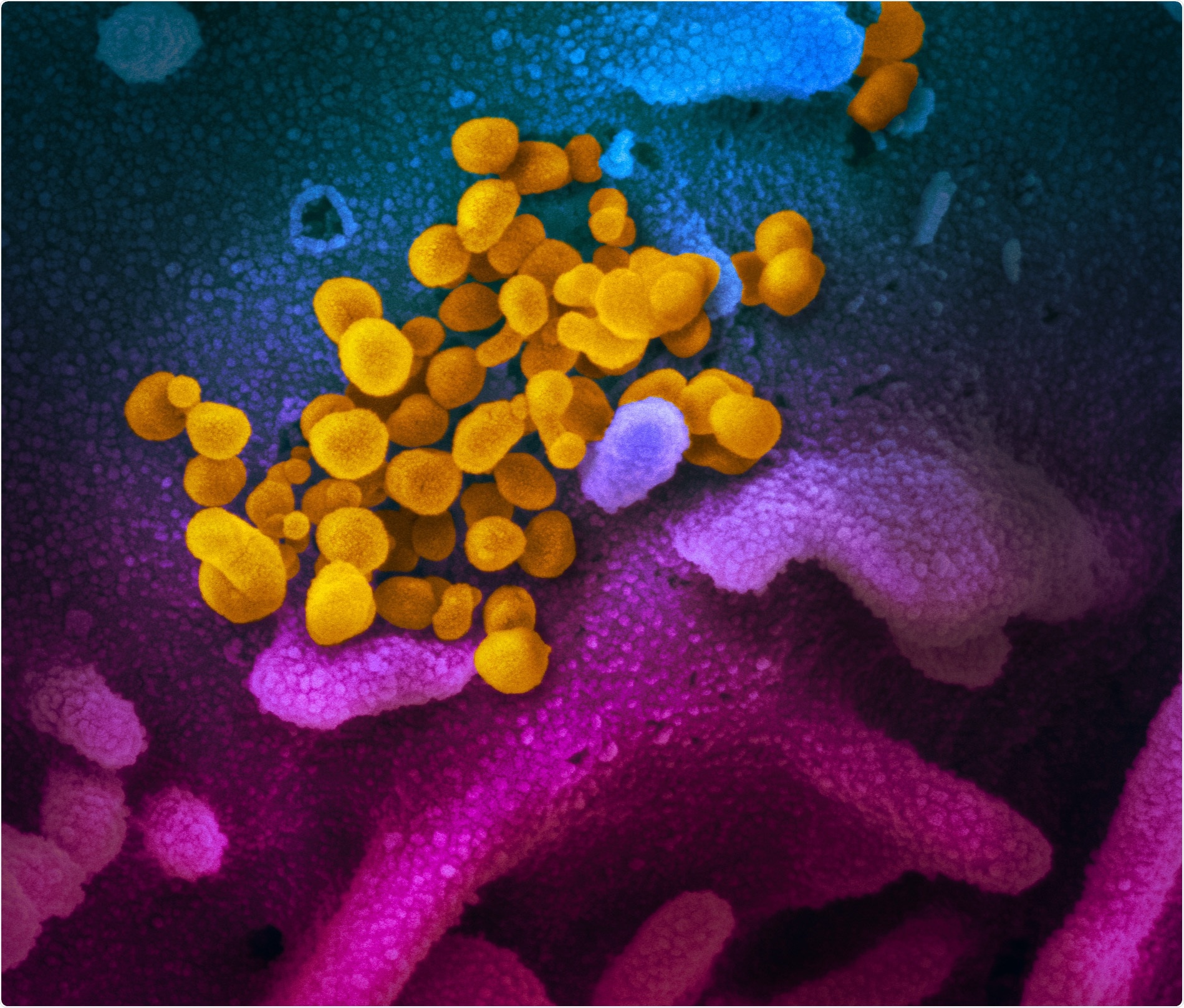 Novel Coronavirus SARS-CoV-2 This scanning electron microscope image shows SARS-CoV-2 (yellow)—also known as 2019-nCoV, the virus that causes COVID-19—isolated from a patient in the U.S., emerging from the surface of cells (blue/pink) cultured in the lab. Image captured and colorized at NIAID