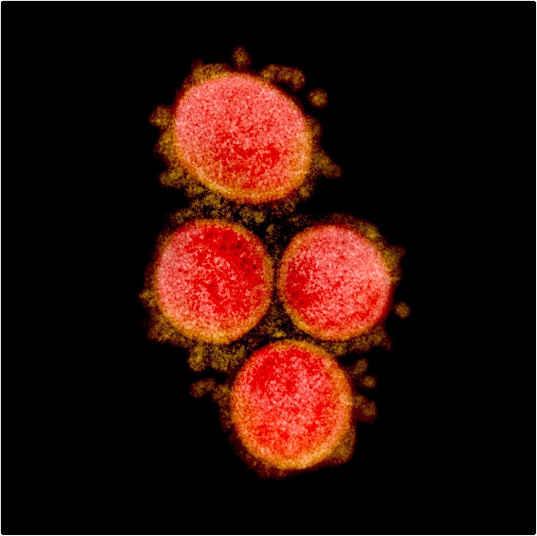 Novel Coronavirus SARS-CoV-2 Transmission electron micrograph of SARS-CoV-2 virus particles, isolated from a patient. Image captured and color-enhanced at the NIAID Integrated Research Facility (IRF) in Fort Detrick, Maryland. Credit: NIAID