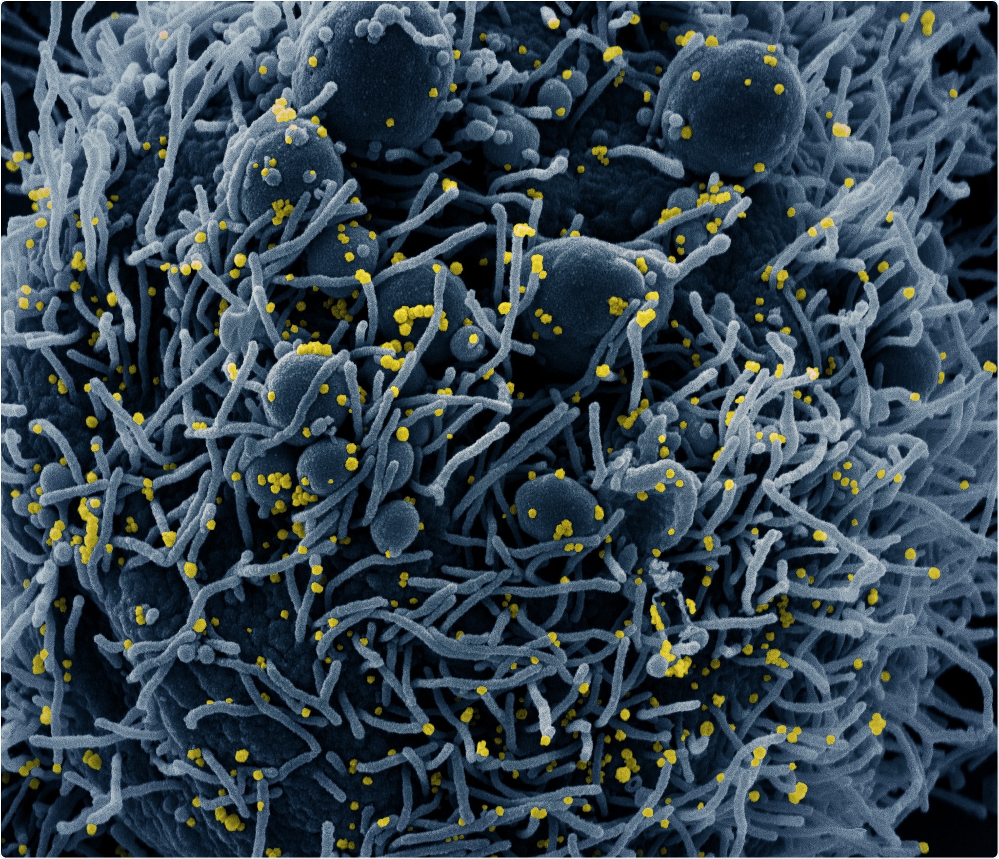 Novel Coronavirus SARS-CoV-2 Colorized scanning electron micrograph of an apoptotic cell (blue) infected with SARS-COV-2 virus particles (yellow), isolated from a patient sample. Image captured at the NIAID Integrated Research Facility (IRF) in Fort Detrick, Maryland. Credit: NIAID