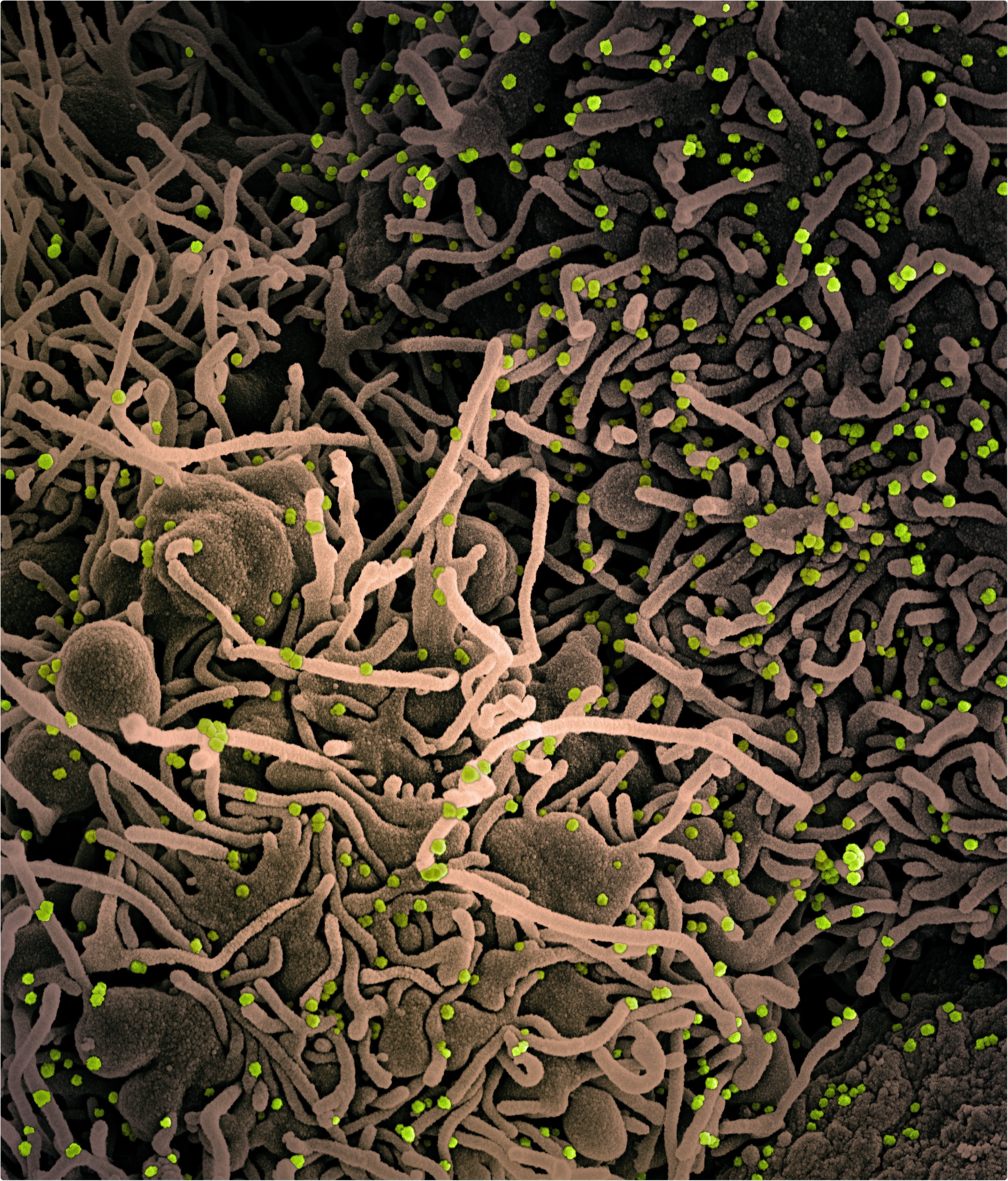 NIAIDFollow Novel Coronavirus SARS-CoV-2 Colorized scanning electron micrograph of a VERO E6 cell (tan) exhibiting elongated cell projections and signs of apoptosis, after infection with SARS-COV-2 virus particles (green), which were isolated from a patient sample. Image captured at the NIAID Integrated Research Facility (IRF) in Fort Detrick, Maryland. Credit: NIAID