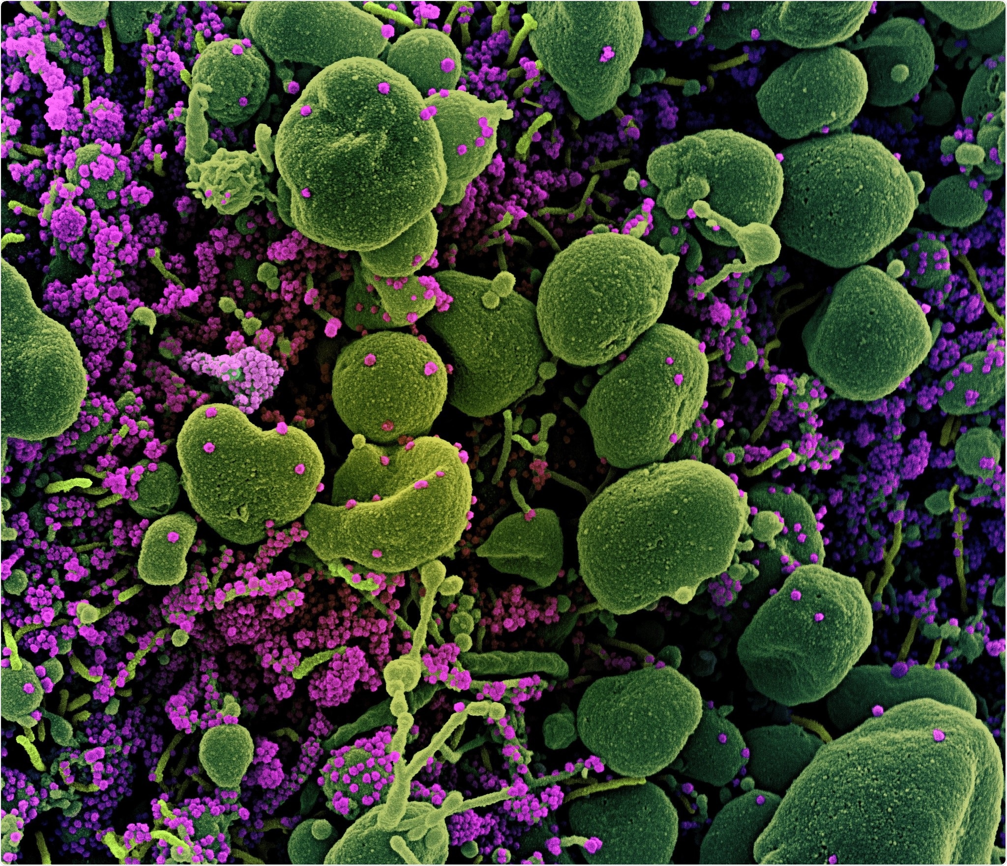 Novel Coronavirus SARS-CoV-2 Colorized scanning electron micrograph of an apoptotic cell (green) heavily infected with SARS-COV-2 virus particles (purple), isolated from a patient sample. Image captured at the NIAID Integrated Research Facility (IRF) in Fort Detrick, Maryland. Credit: NIAID