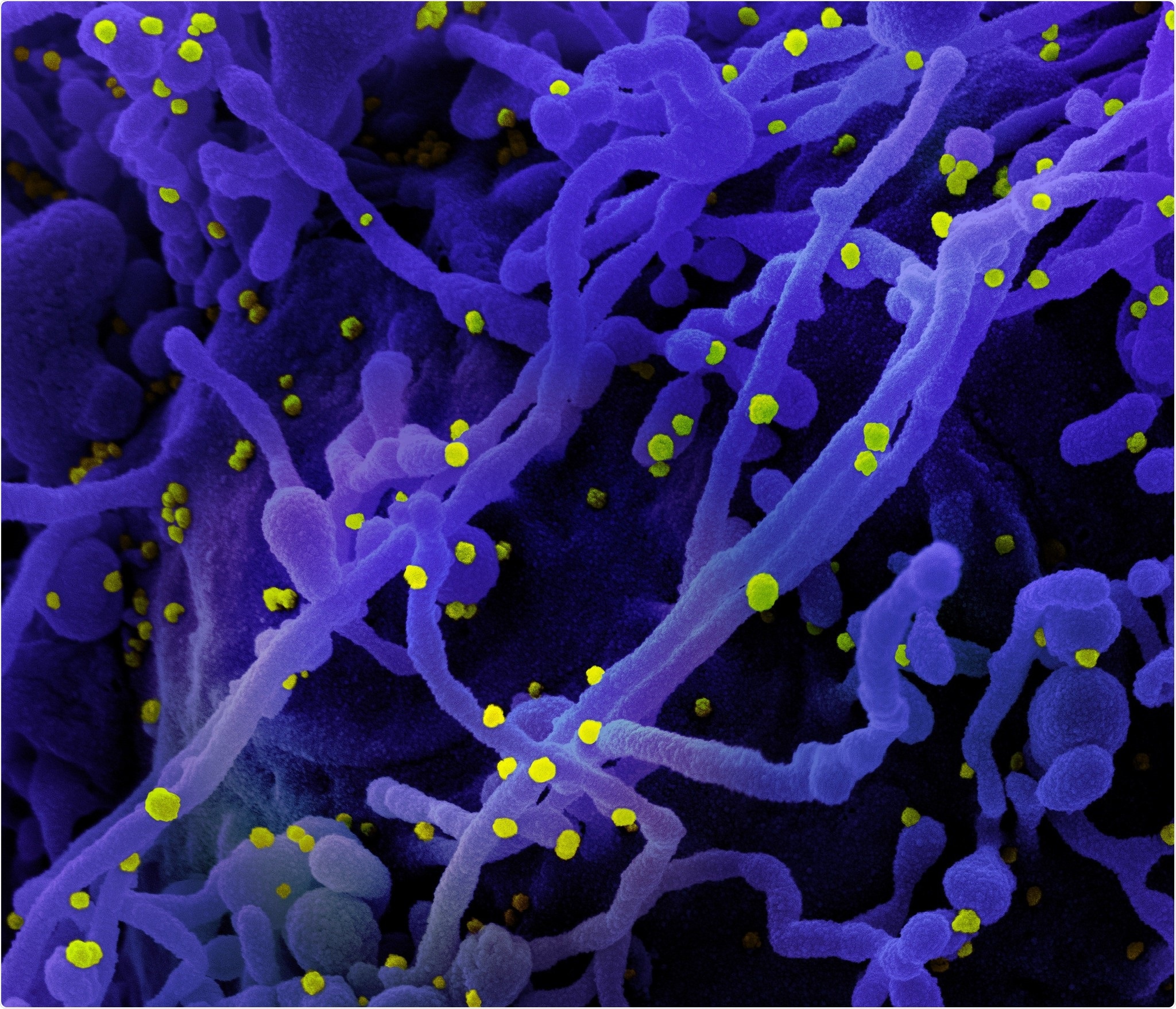 Microscopio elettronico a scansione novello di Coronavirus SARS-CoV-2 Colorized di una cella (porpora) infettata con le particelle del virus SARS-COV-2 (giallo), isolate da un campione paziente. L