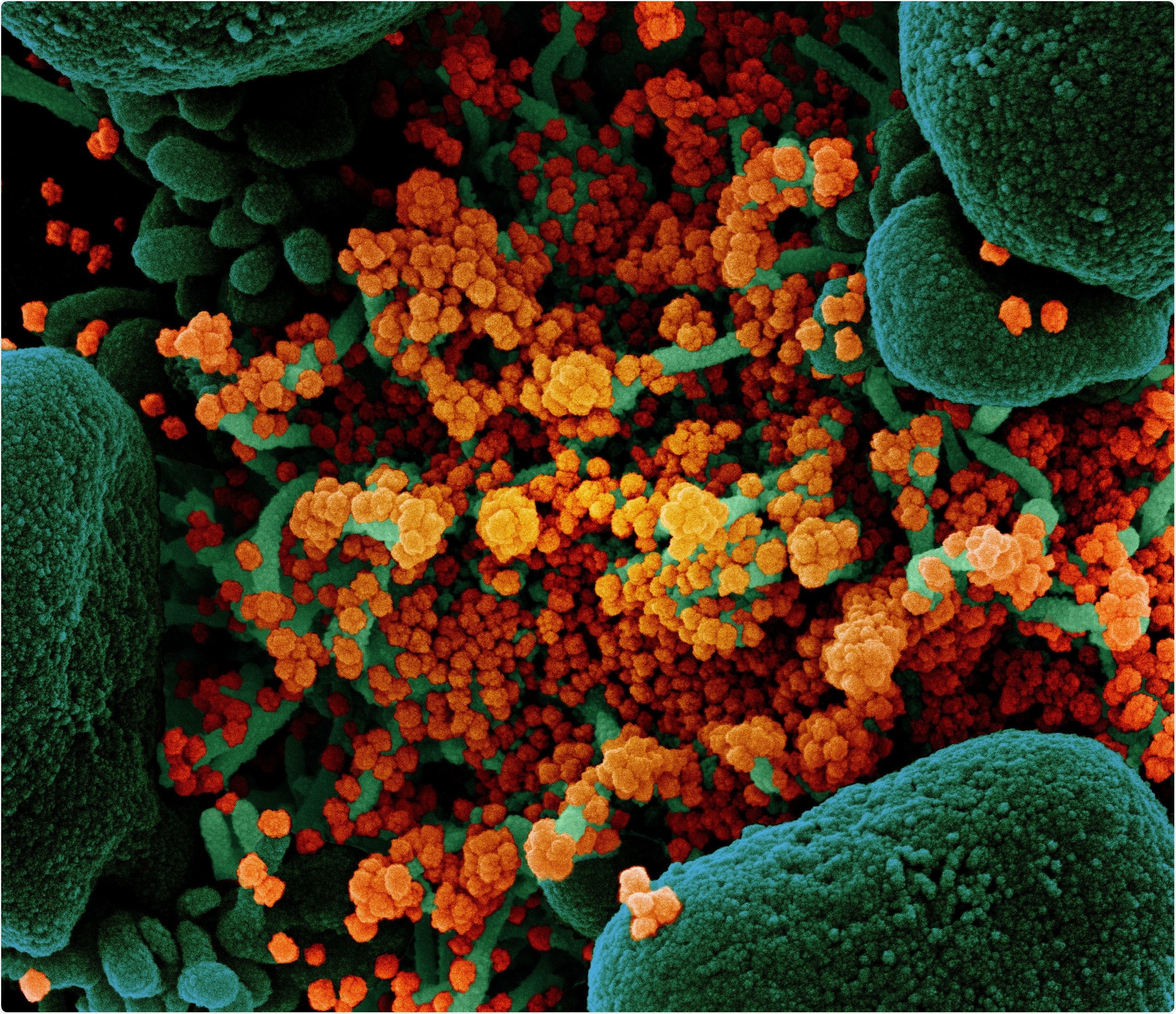 Novel Coronavirus SARS-CoV-2 Colorized scanning electron micrograph of an apoptotic cell (green) heavily infected with SARS-COV-2 virus particles (orange), isolated from a patient sample. Image at the NIAID Integrated Research Facility (IRF) in Fort Detrick, Maryland. Credit: NIAID