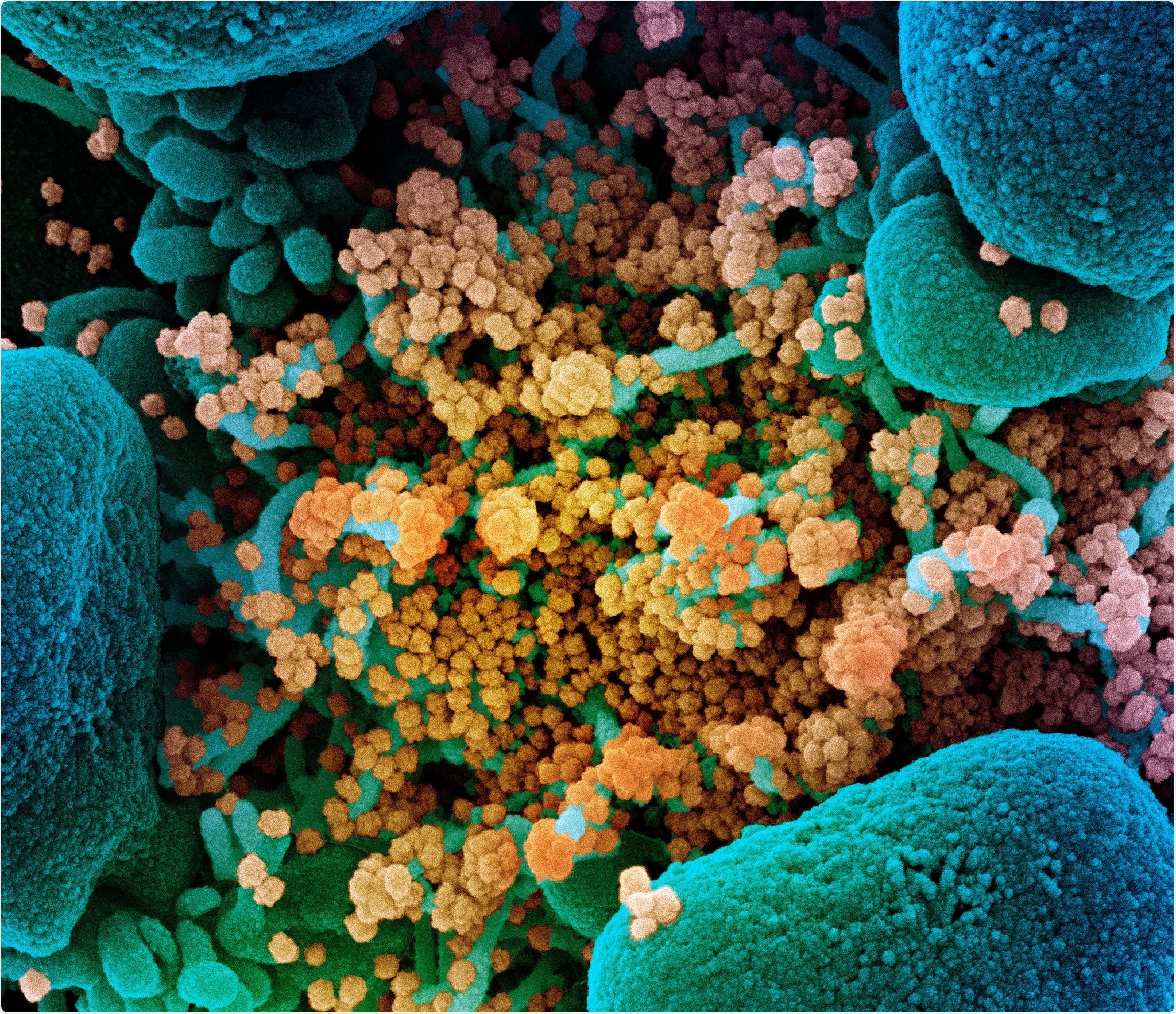 Novel Coronavirus SARS-CoV-2 Colorized scanning electron micrograph of an apoptotic cell (blue) heavily infected with SARS-COV-2 virus particles (yellow), isolated from a patient sample. Image captured at the NIAID Integrated Research Facility (IRF) in Fort Detrick, Maryland. Credit: NIAID