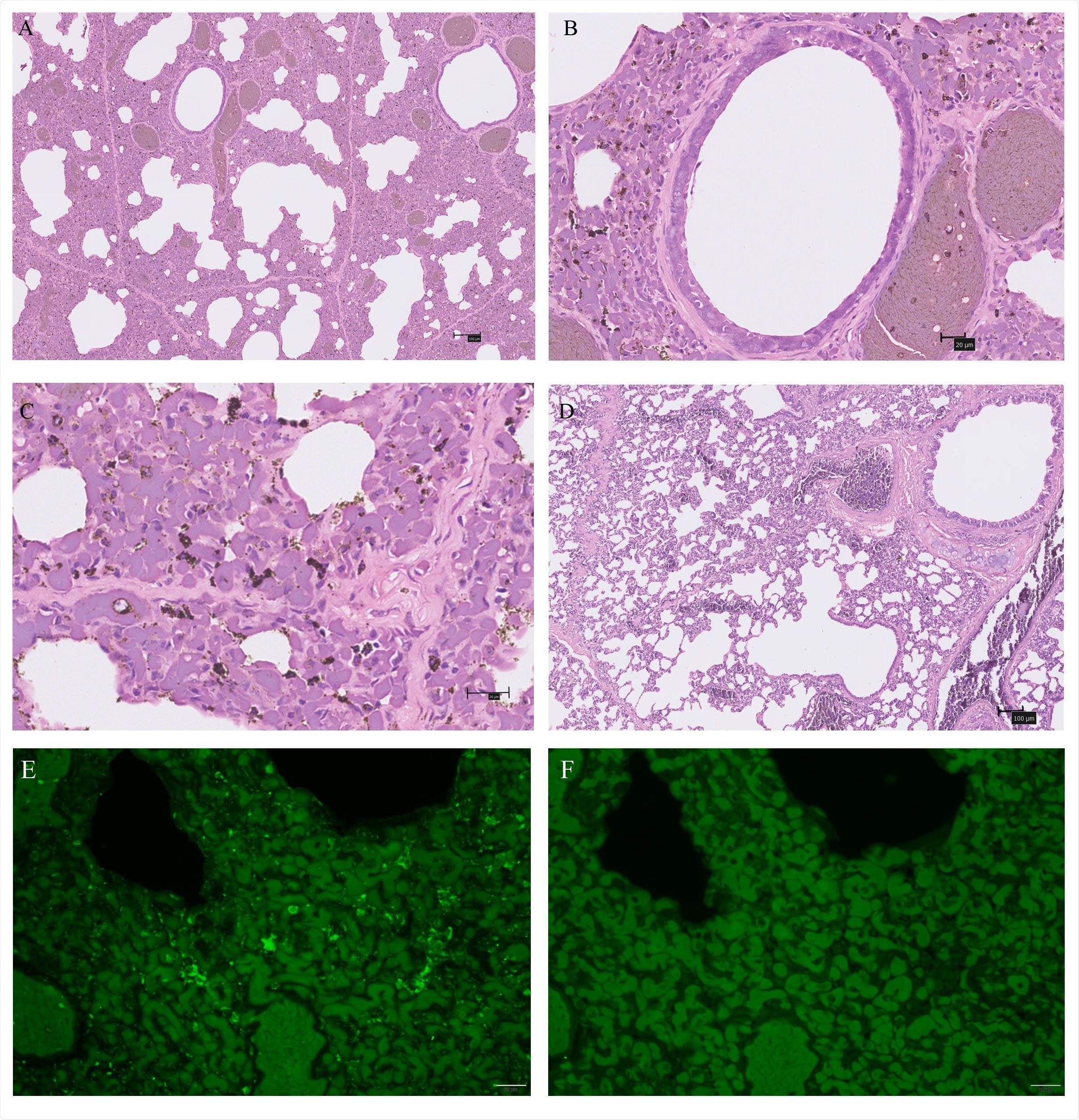 Characteristic pathological changes and virus antigen expression in the lungs of one SARSr-CoV-2 positive pangolin . (A-C) An autopsy lung with SARSr-CoV-2 infection compared to a negative one (D) were stained by hematoxylin and eosin (H&E). (B) bronchiectasis; (C) the interstitium and the walls of the alveoli thicken. (E-F) Immunofluorescence for virus antigen expression in pneumocytes. (E) nucleocapsid of SARS-CoV-2 (Green); (F) negative control. Scale bars of (A) and (D) are 100um, while others are 20um.