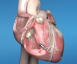 Glenfield Hospital first in the UK and Ireland to implant world’s smallest, wireless pacemaker