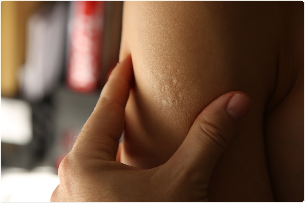 Bacille Calmette Guerin vaccine (BCG) skin scars. Image Credit: MD_Photography / Shutterstock