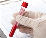 Blood test may predict a patient’s response to prostate cancer treatment