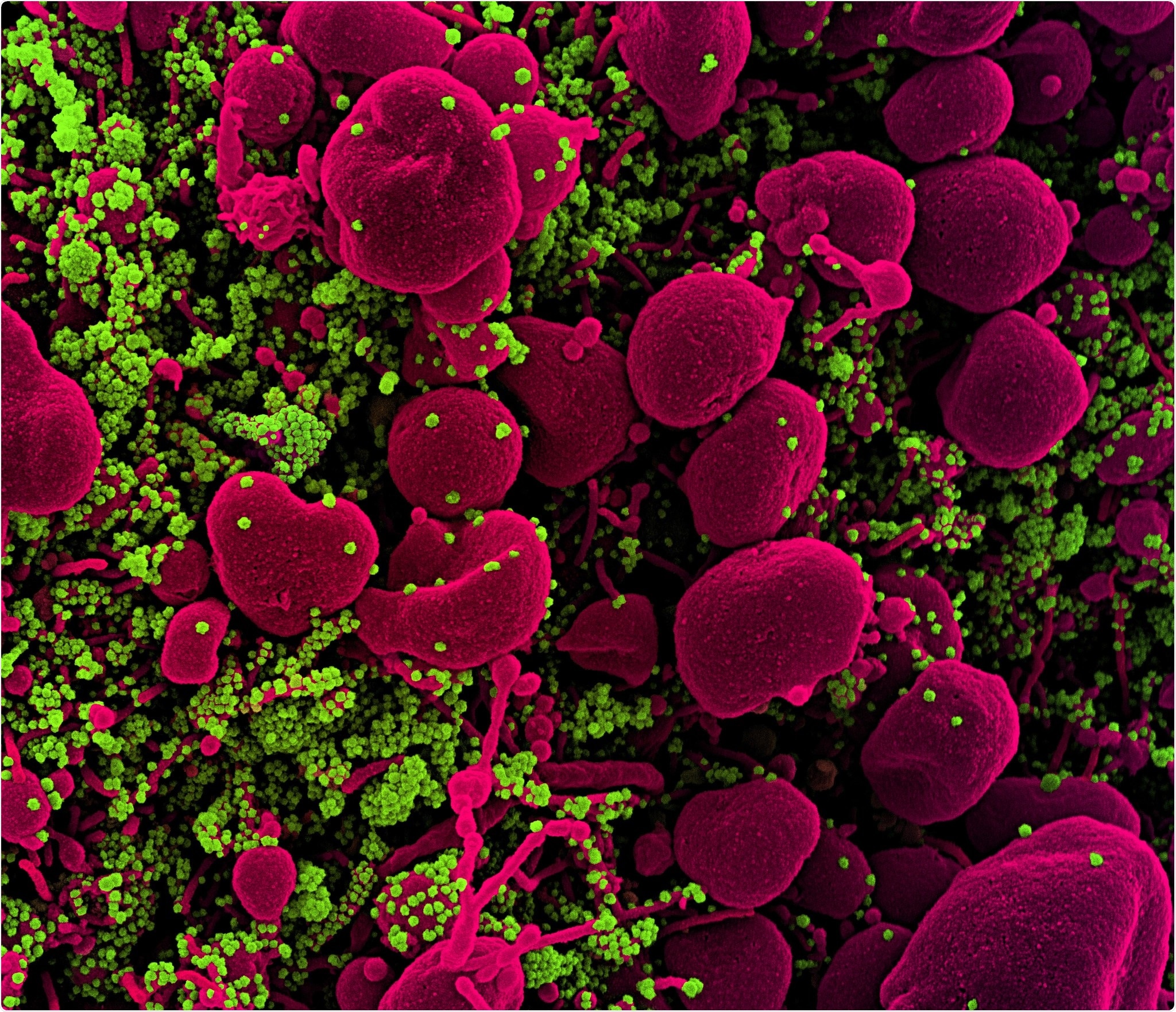 Micrográfo de electrón nuevo de la exploración de Coronavirus SARS-CoV-2 Colorized de una célula apoptotic (festonear) infectada pesado con las partículas del virus SARS-CoV-2 (verde), aisladas de una muestra paciente. La imagen capturada en el NIAID integró el centro de investigación en el fuerte Detrick, Maryland. Haber: NIAID