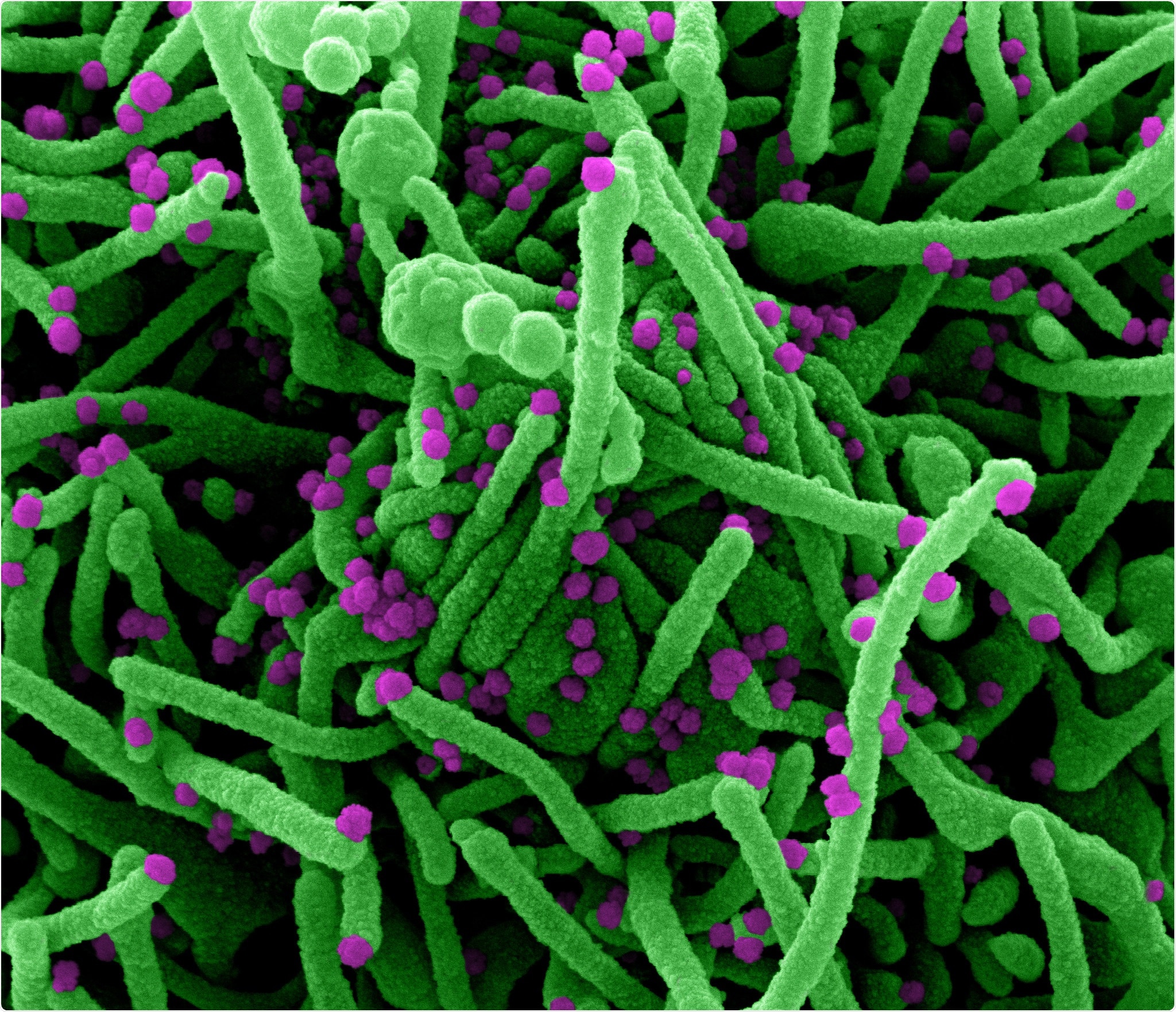 Micrográfo de electrón de la exploración de Colorized de una célula (verde) infectada con las partículas del virus SARS-CoV-2 (púrpuras), aisladas de una muestra paciente. La imagen capturada en el NIAID integró el centro de investigación en el fuerte Detrick, Maryland. Haber: NIAID