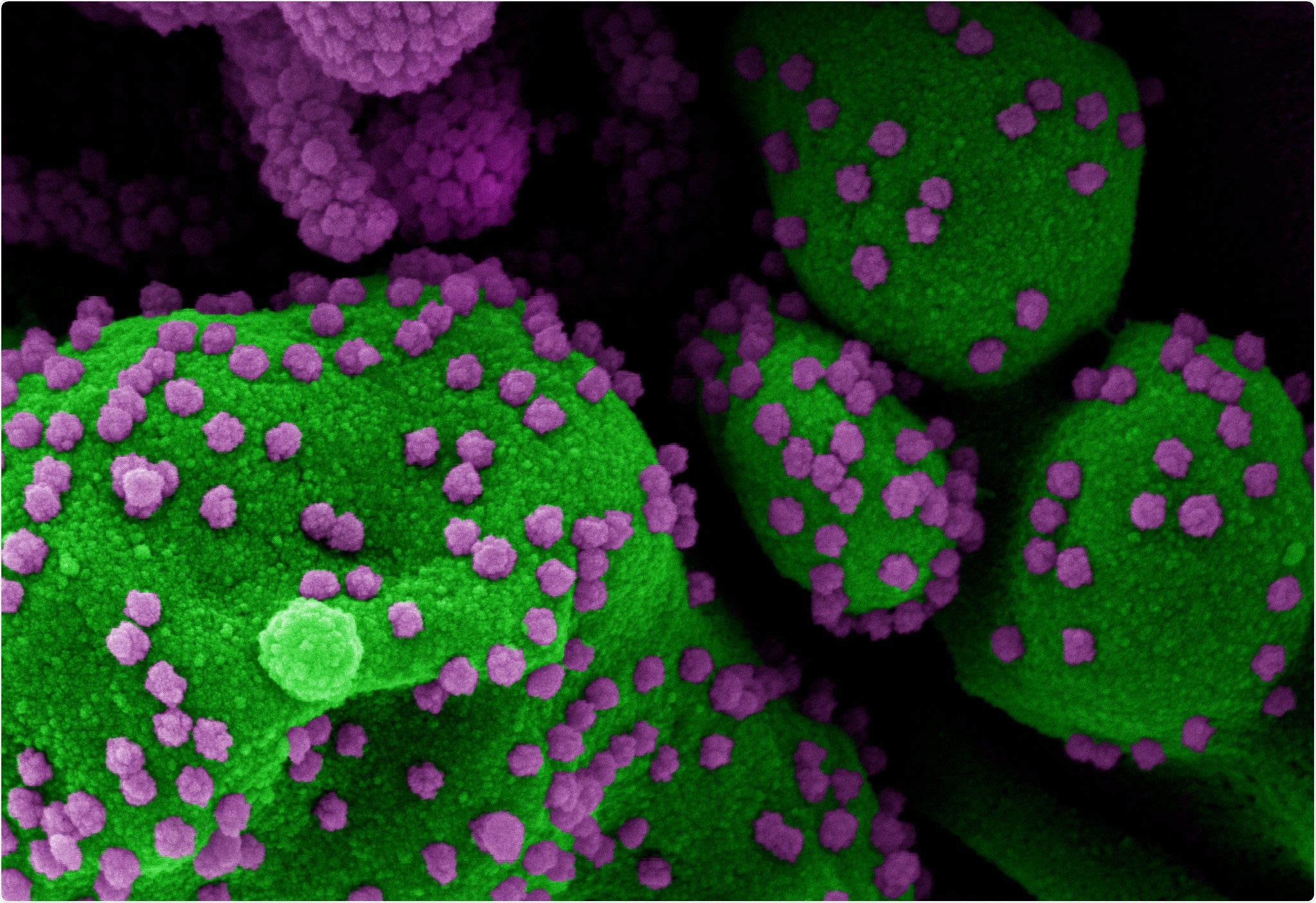 Novel Coronavirus SARS-CoV-2 Colorized scanning electron micrograph of an apoptotic cell (green) heavily infected with SARS-CoV-2 virus particles (purple), isolated from a patient sample. Image at the NIAID Integrated Research Facility (IRF) in Fort Detrick, Maryland. Credit: NIAID