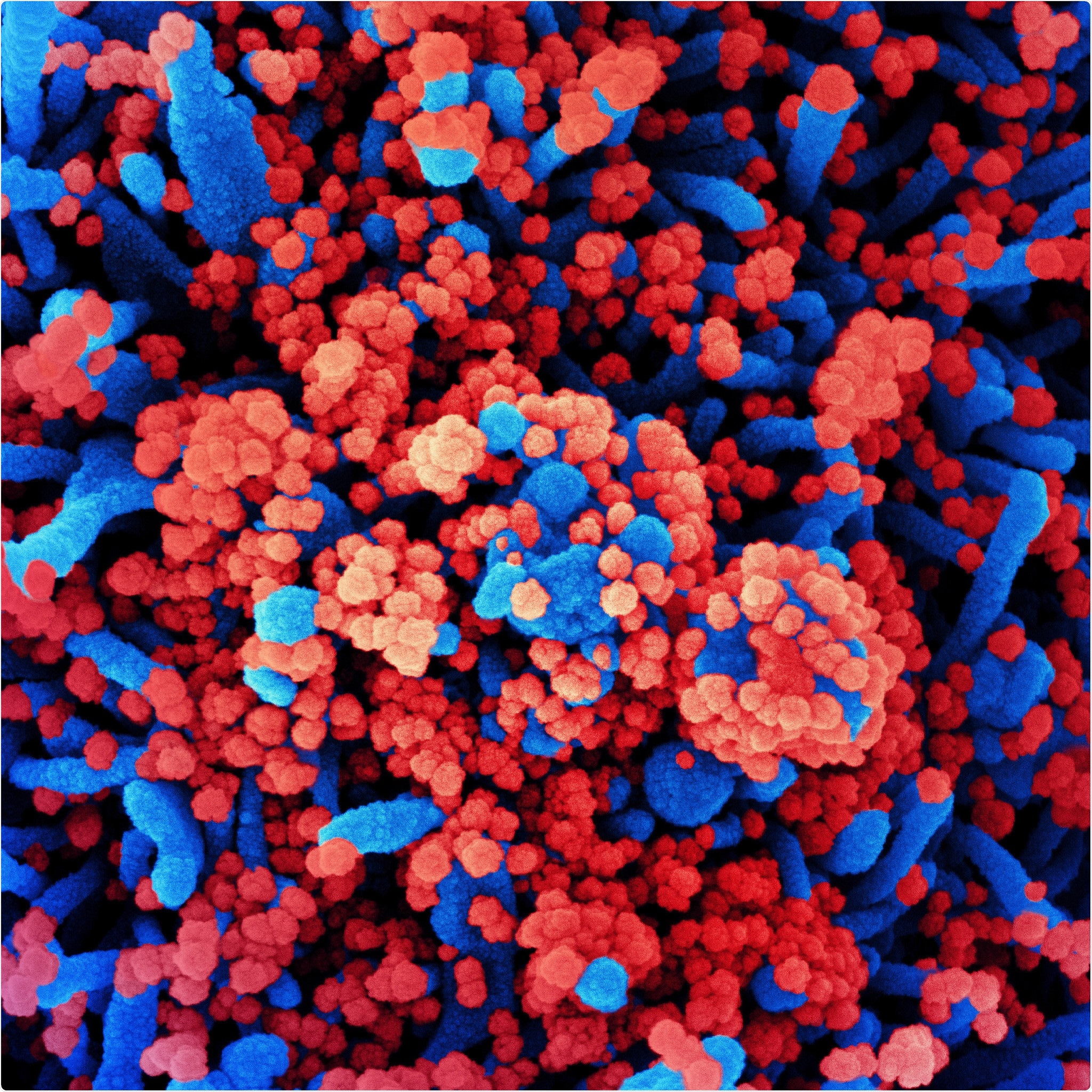 Novel Coronavirus SARS-CoV-2 Colorized scanning electron micrograph of a cell (blue) heavily infected with SARS-CoV-2 virus particles (red), isolated from a patient sample. Image captured at the NIAID Integrated Research Facility (IRF) in Fort Detrick, Maryland. Credit: NIAID