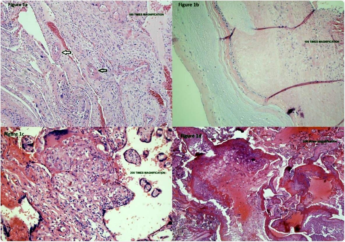 Placental vasculopathy in a pregnant woman with mild COVID-19 disease. Placental membranes showed decidua with scattered arterioles with thickened smooth muscle, consistent with hypertrophic arteriolopathy (vasculopathy) (Figure 1a – umbilical cord and placental membranes) and subchorionic laminar necrosis (Figure 1b – placental parenchyma under the umbilical cord). Placental disc showed focal areas of lympho-histiocytic inflammation consistent with chronic villitis (Figure 1c – central placental parenchyma) and scattered islands of extravillous trophoblasts (Figure 1d – peripheral placental parenchyma).