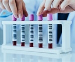 New blood test can detect prostate cancer and confirm the stage of the disease