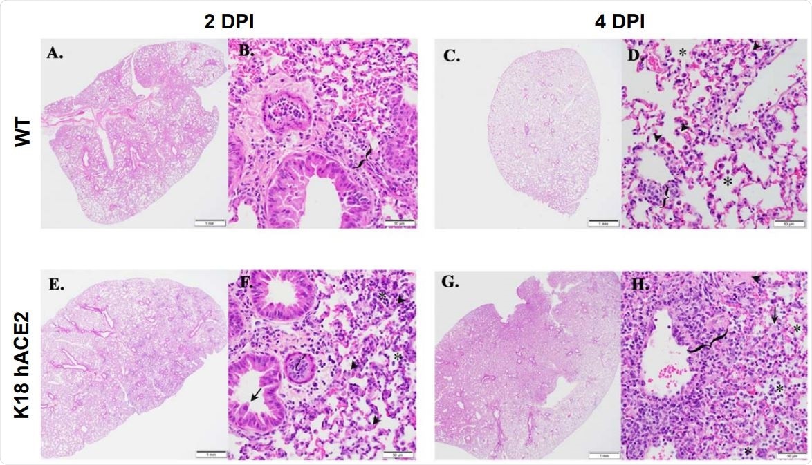 K18 hACE2 transgenic mice develop rhinitis, pneumonia with associated pulmonary inflammation after infection with SARS-CoV-2. (A-D and I-L) WT C57BL/6 mice. Minimal mononuclear and neutrophilic interstitial pneumonia in WT lung at 2-DPI (A, B bracket). By 4-DPI (5C, D) minimal alveolar histiocytosis (D, asterisk) pneumocyte type II cells (D, arrowheads), perivascular mononuclear inflammation (D, bracket) and rhinitis with low numbers of neutrophils (K, arrowhead) were variably observed. Lymphocyte aggregates in the lamina propria of the small intestine (I, asterisk). Mixed mononuclear inflammation with individual hepatocellular necrosis (J, arrowhead). Brain from WT 4-DPI was normal (L). (E-H and M-P) K18 hACE2 transgenic mice. Interstitial pneumonia (E, F) associated with alveolar histiocytosis admixed neutrophils and lymphocytes (F, asterisks), mild type II pneumocyte hyperplasia (F, arrowhead), bronchiolar syncytia (F, arrow), endothelial cells hyperplasia and vasculitis (F, bracket) by 2-DPI. Gut associated lymphoid tissue (GALT) with prominent germinal centers was observed (M, asterisk). Liver inflammation with variable amounts of individual hepatocellular necrosis (N, arrowhead). Greater lung involvement indicative of pneumonia (G), with inflammatory cellular accumulations and hemorrhage in alveolar spaces (H, asterisk) and interstitium (H, bracket), intra-alveolar fibrin admixed cellular debris (H, arrow), vasculitis (H, bracket), edema (H, arrowhead) by 4-DPI. Neutrophilic rhinitis observed at 4-DPI (O, bracket). Mild meningoencephalitis with vasculitis (P, arrowhead). Scale bars left images, 1 mm. Scale bars right images, 50 mm. DPI: Days post-infection.
