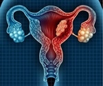 Newly discovered endometrial cancer biomarker enables early detection and treatment