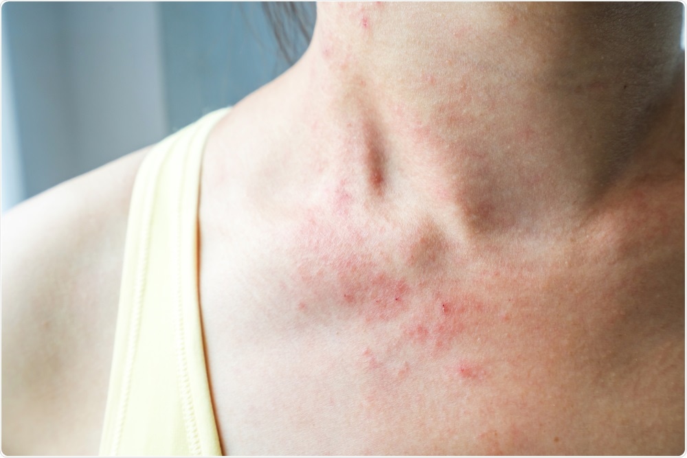 Study: Diagnostic value of skin manifestation of SARS-CoV-2 infection. Image Credit: kitzcorner / Shutterstock