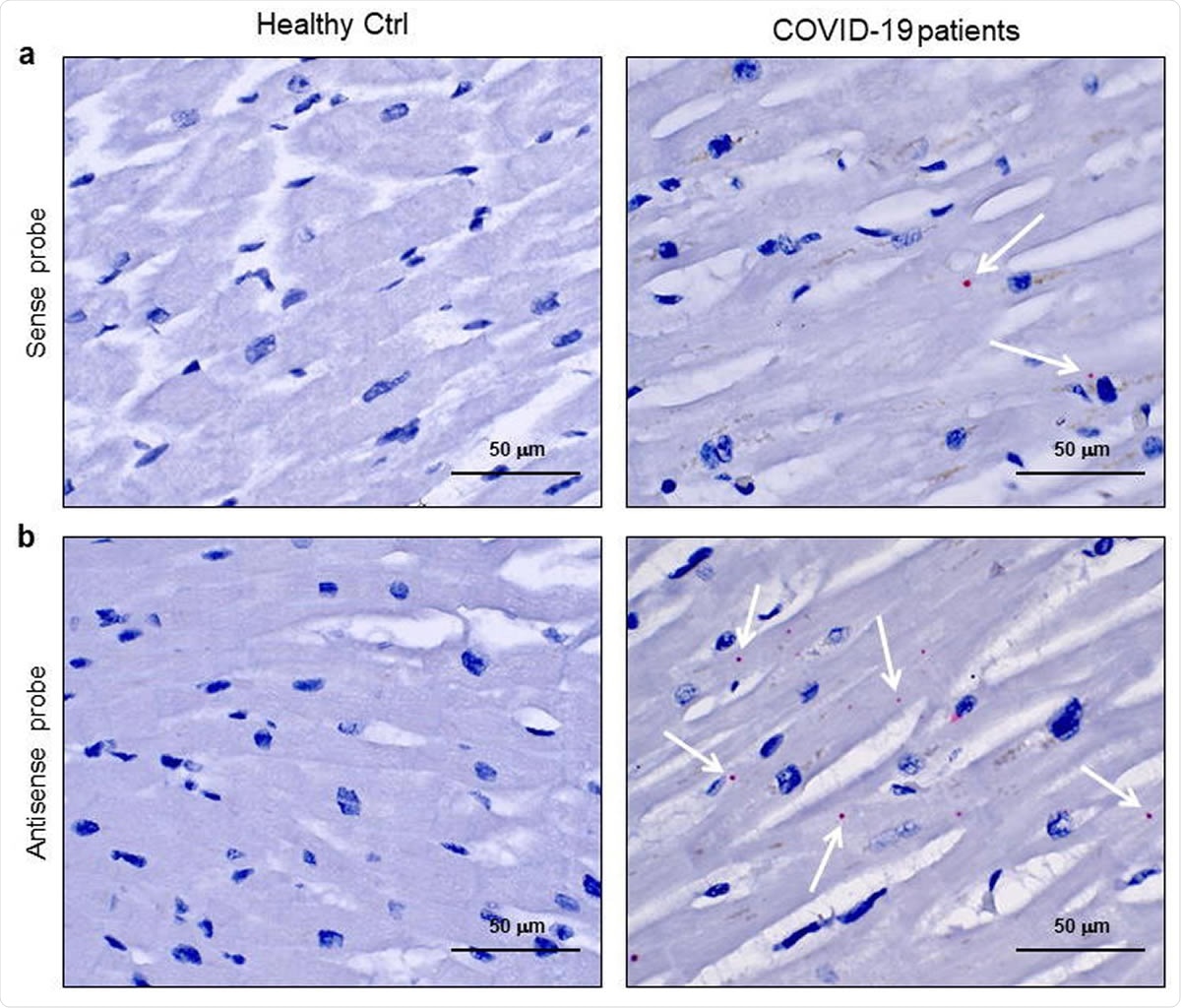 SARS-CoV-2 sense and antisense RNA are localized into cardiomyocytes of COVID-19 patients. a-b) Representative images of spatially resolved viral RNA detection by RNAScope assay on 3μmslides of formalin-fixed paraffin-embedded left ventricle specimens from healthy control (Healthy Ctrl, left panels) and COVID-19 patients (COVID-19, central and right panels) for SARS-CoV-2 sense (a) and antisense (b) probes for spike protein RNA sequences. Fast Red dots indicate viral RNA presence (white arrows). Nuclei have been counterstained with haematoxylin. Magnification as scale bars.